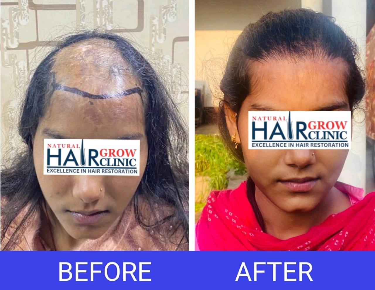 Hair Transplant Result