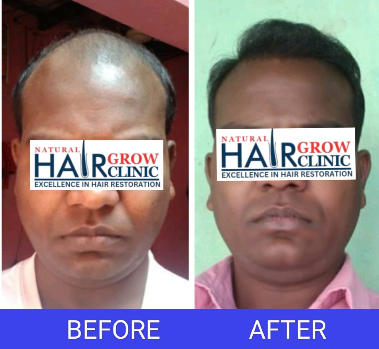 Hair Transplant Result
