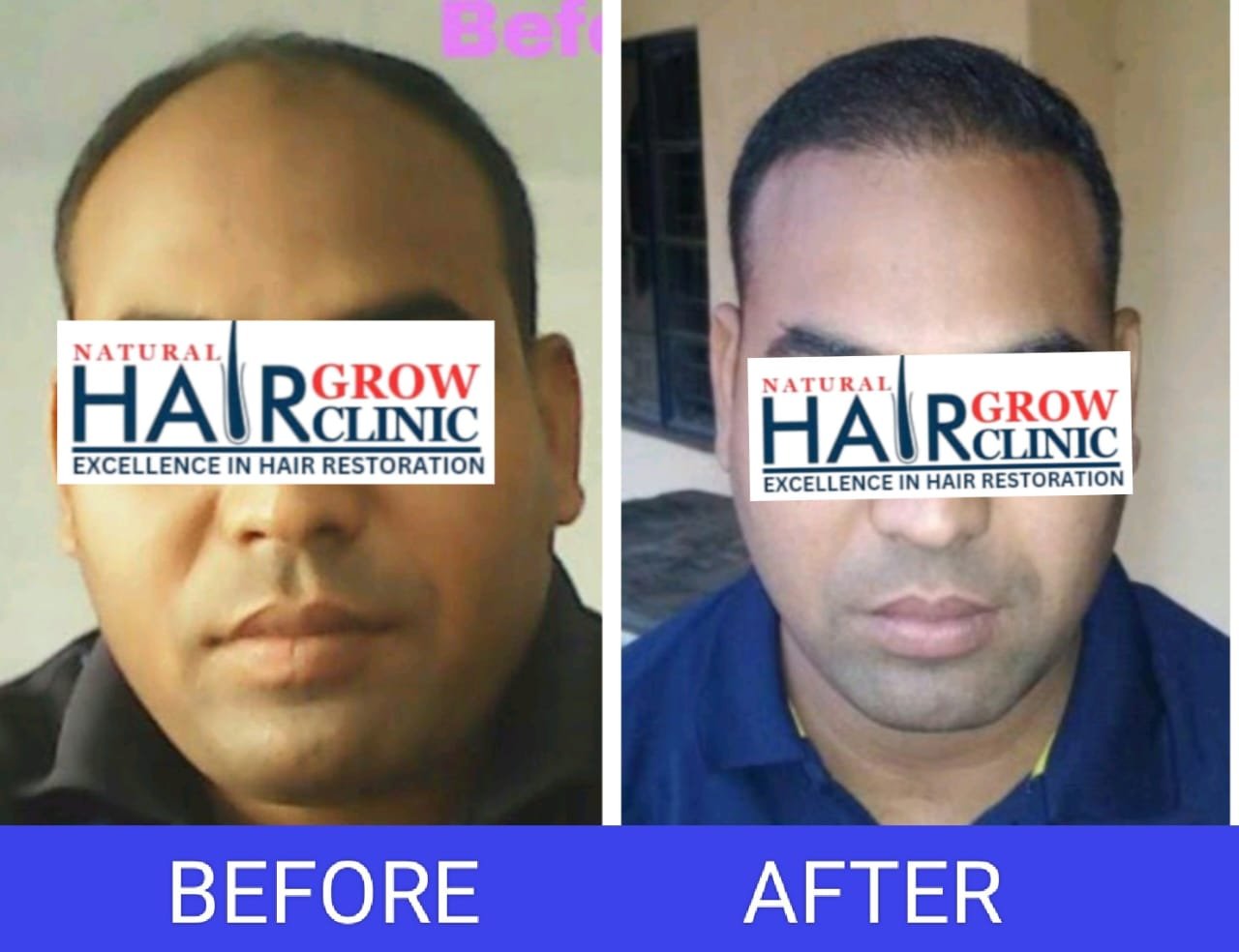 Hair Transplant Result