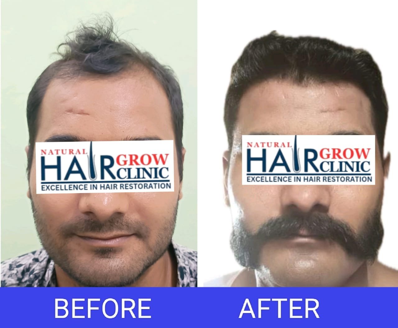 Hair Transplant Result