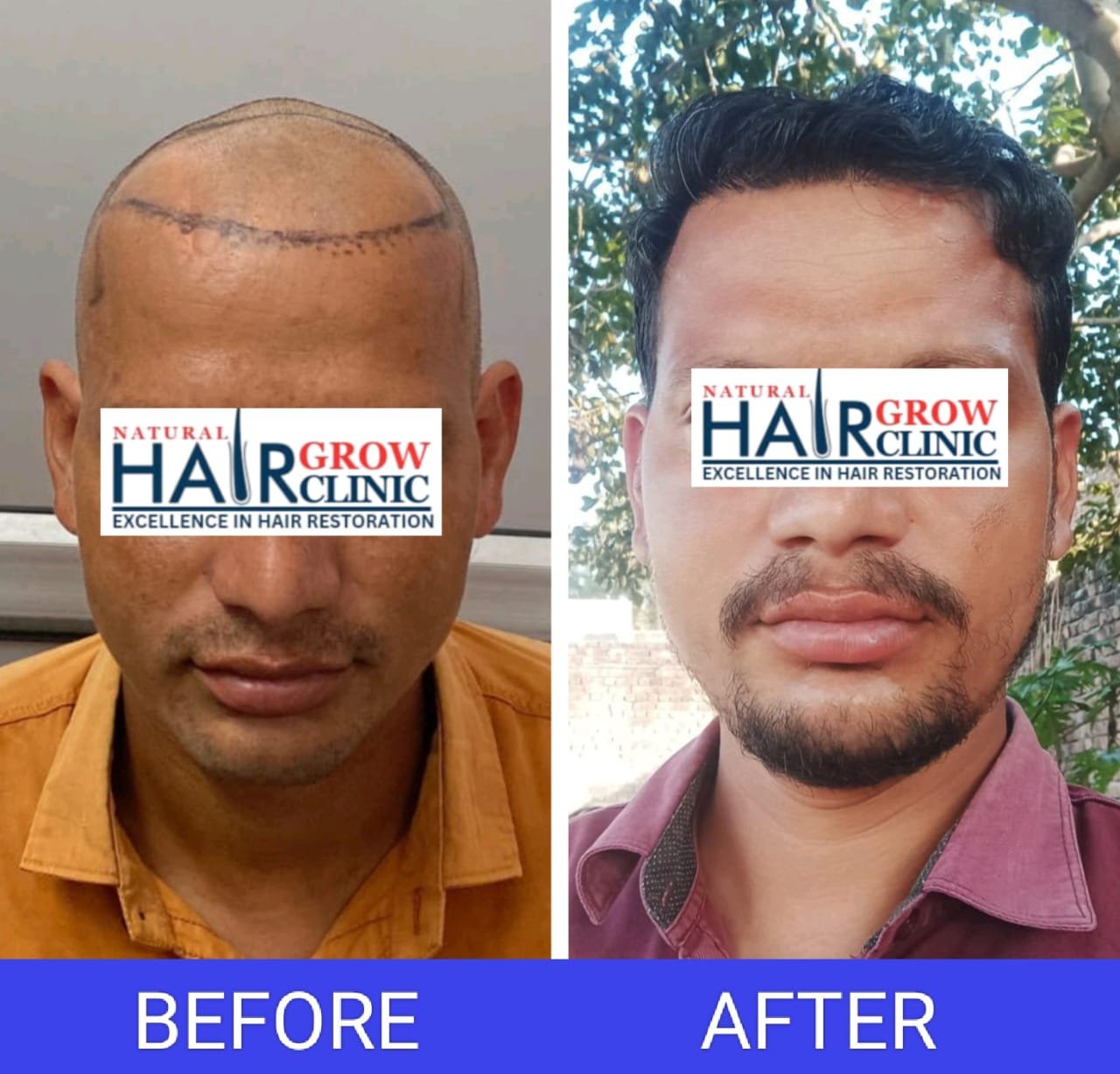 Hair Transplant Result