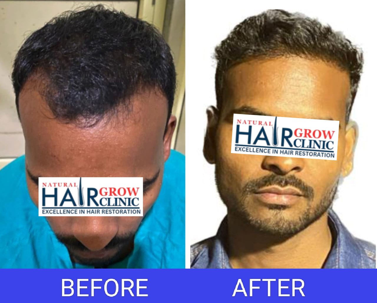 Hair Transplant Result