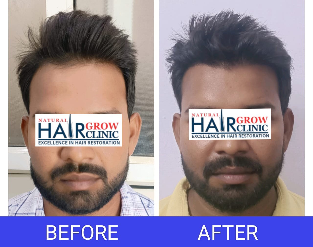 Hair Transplant Result