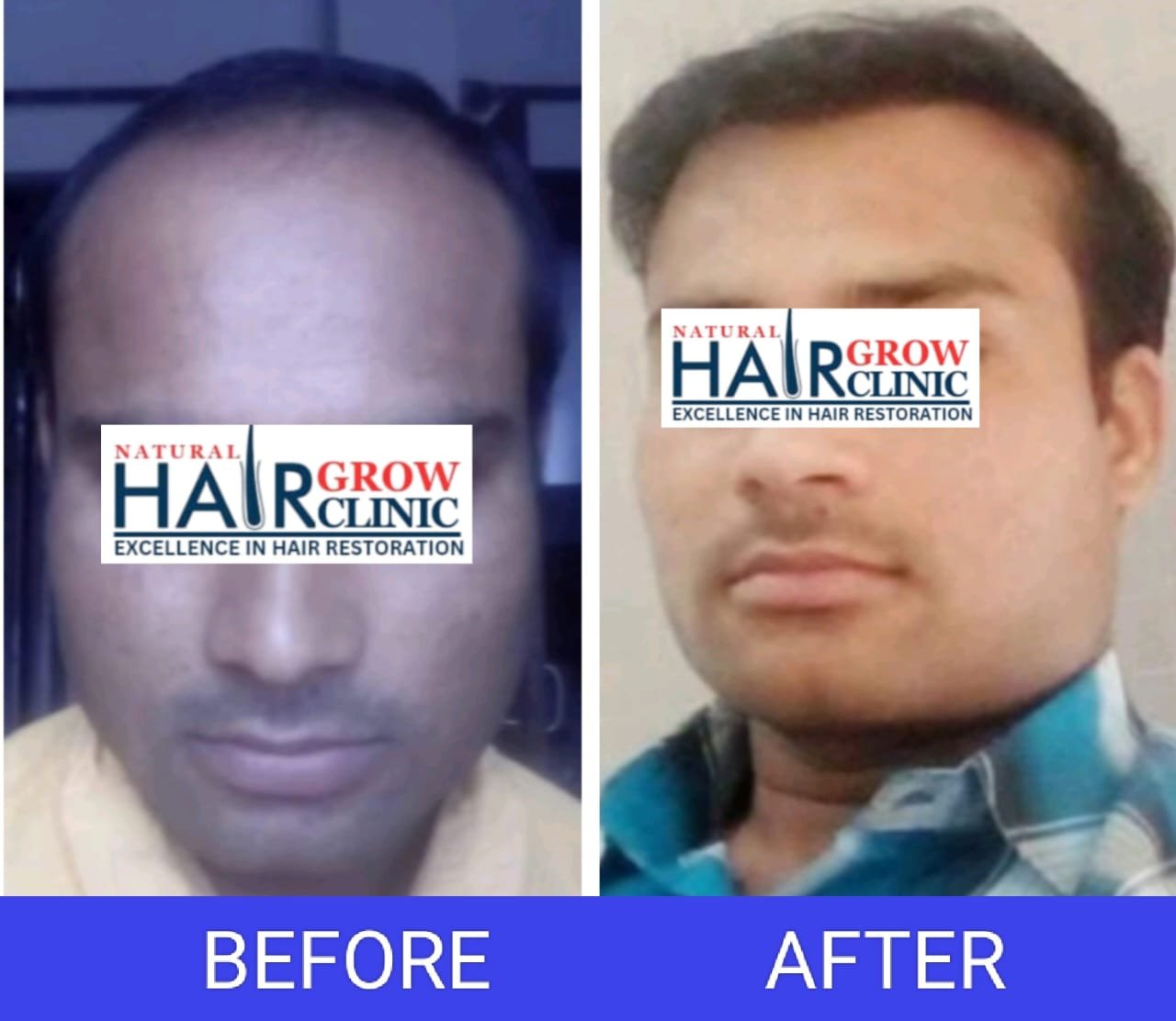 Hair Transplant Result