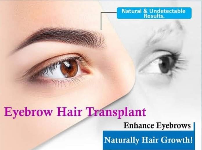 Eyebrow Transplant