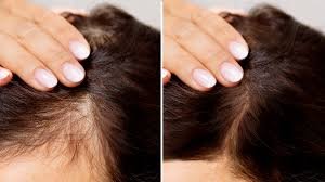 Hair Fall Treatment