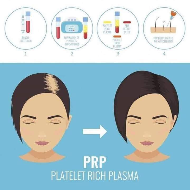 PRP Therapy